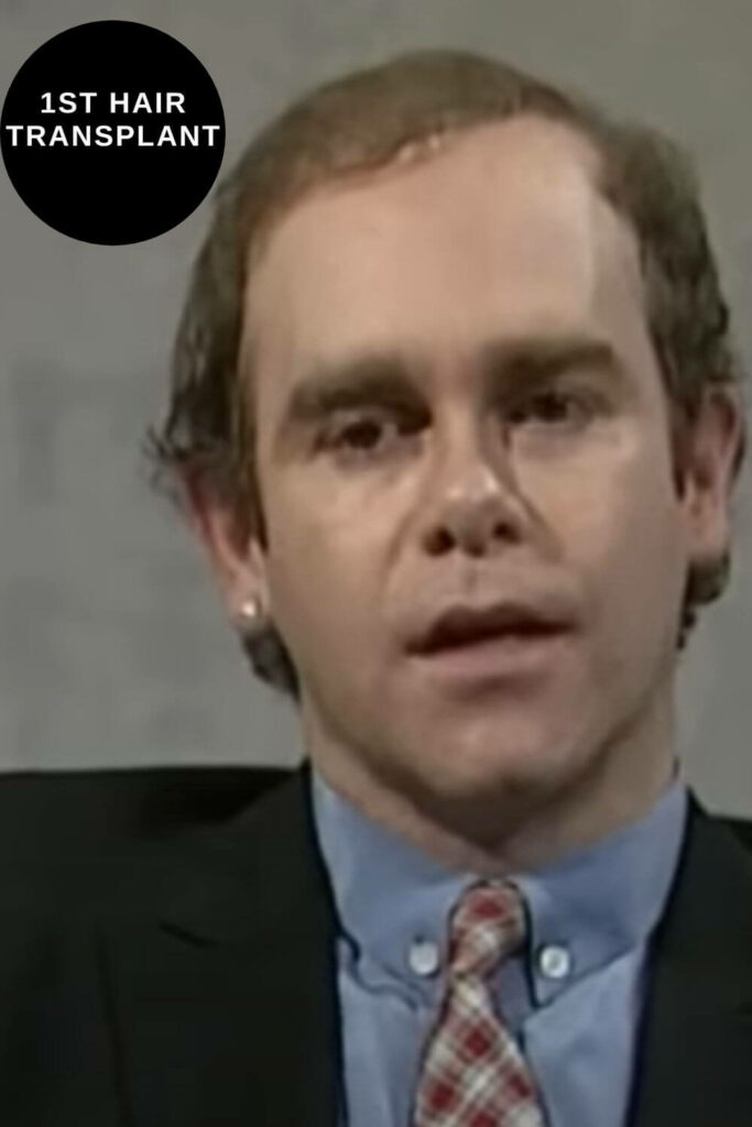 Hair Transplant